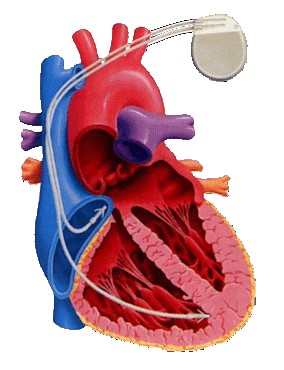 Komplettes Herzschrittmachersystem